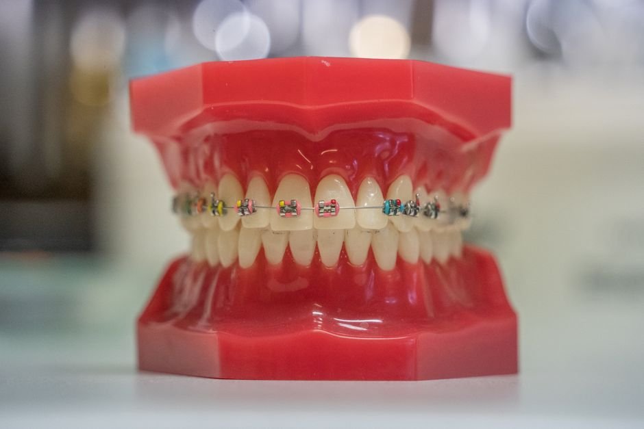 How Diet Affects Orthodontic Treatment Progress