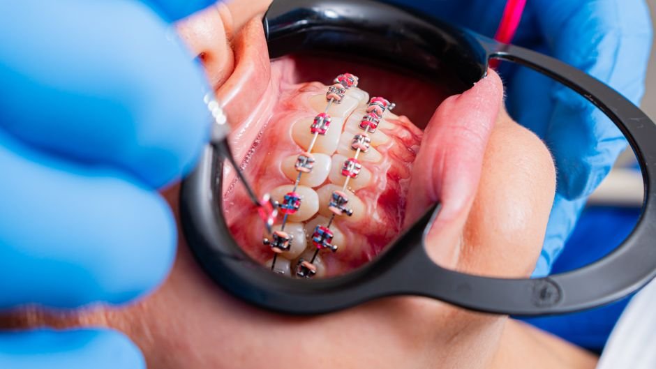 How Orthodontic Treatment Supports Long Term Jaw Health